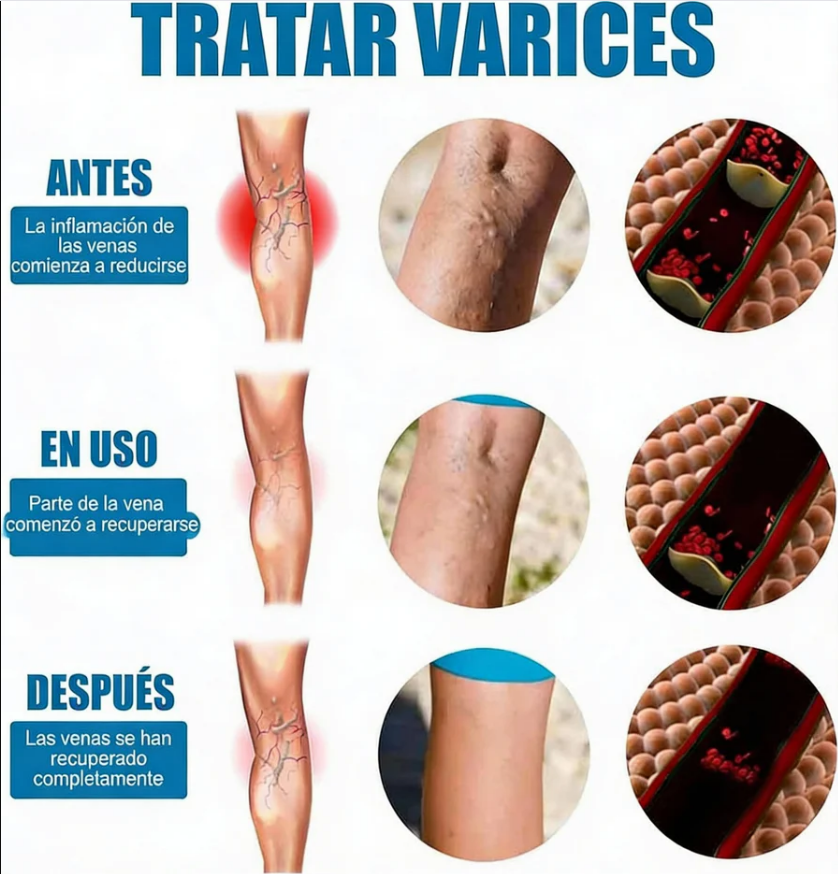 OFERTA ÚNICA 🔥 Spray Milagroso Para Venas Varicosas